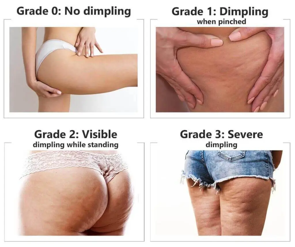 Visual guide showing different levels of skin dimpling on legs and thighs